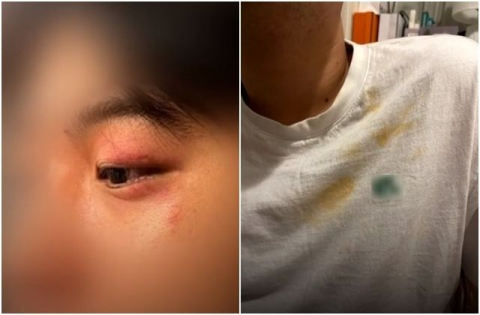 이탈리아 관광 중 괴한들에게 폭행당하고 금품을 빼앗긴 20대 A씨. JTBC 보도화면 캡처