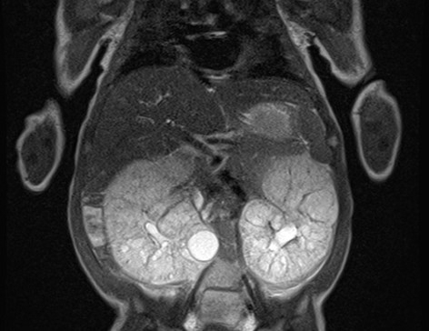 상염색체 열성 다낭성 신장 질환(ARPKD)을 앓고 있는 소아환자의 복부 자기공명영상장치(MRI) 사진. 경북대병원 제공.