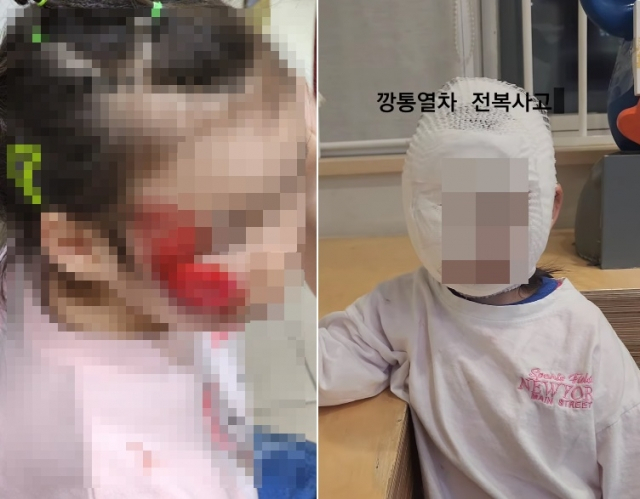 얼굴이 다친 A씨의 자녀. A씨 인스타그램.