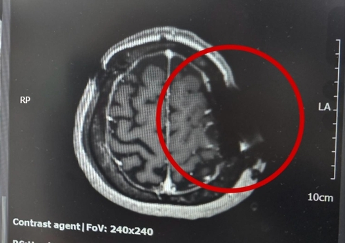 동그라미 부근의 머리뼈에 쇠톱 날이 박혀 자기공명영상(MRI)이 제대로 찍히지 않았다. MRI는 자기공명을 이용하는데 금속 물질이 있어 정상적으로 작동하지 않았다고 한다. 연합뉴스.
