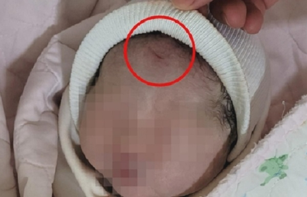 부산의 한 산부인과 병원에서 제왕절개로 태어난 아기의 이마 두 곳이 찢어져 있다. 연합뉴스