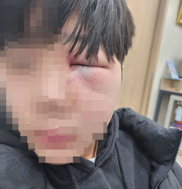 학교 폭력으로 망막이 훼손된 학생 얼굴. 연합뉴스