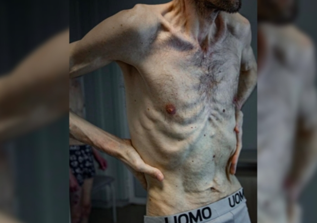 전쟁 중 러시아에 포로로 붙잡혔다가 2년 만에 우크라이나로 돌아온 남성의 앙상한 모습이 공개됐다. 엑스 캡처