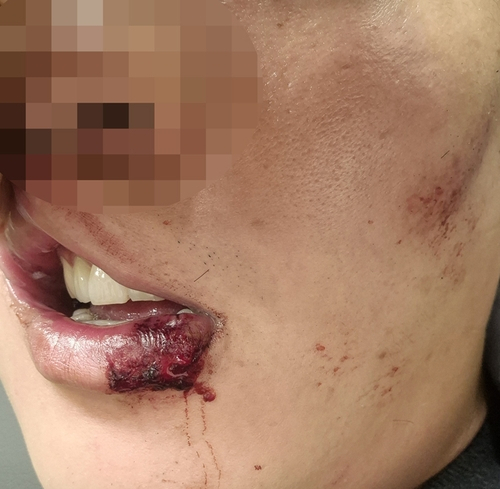 체포 과정에서 다친 A씨. 연합뉴스