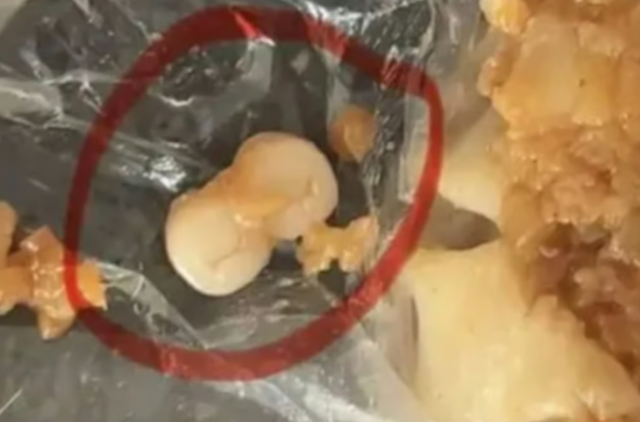 중국 광둥성 둥관시 유명 딤섬 프랜차이즈 매장을 방문한 한 여성은 아버지가 먹던 딤섬 안에서 사람의 치아 두 개를 발견했다고 밝혔다. 웨이보