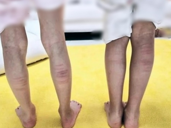 자녀에게 심한 체벌을 가한 뒤, 그 상처를 사진으로 촬영해 소셜미디어에 올린 한 여성의 게시물. JTBC 