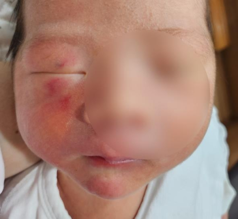 '생후 4일' 신생아 얼굴에 붉은 상처…병원에서 무슨 일?