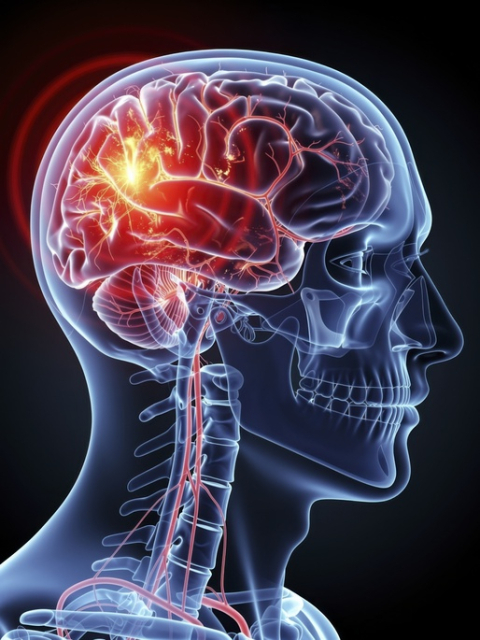[건강플러스] '조용한 시한폭탄' 뇌동맥류