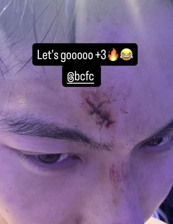 4일 경기 직후 백승호가 다친 이마 부위를 꿰맨 모습. 버밍엄시티 SNS 제공