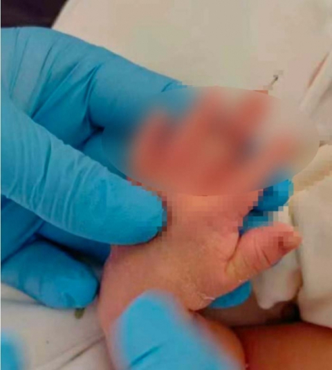 신생아 탯줄 자르다 손가락 잘랐다…中 병원 황당 사고 '발칵'