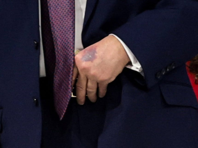 '건강 이상설' 트럼프 손등에 시퍼런 멍자국?…