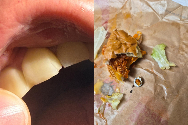 햄버거속 볼트 씹어 치료비 100만원 '날벼락'…