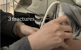 골절 부상 딛고 금메달…병원 찾은 최가온 '3 fractures'?