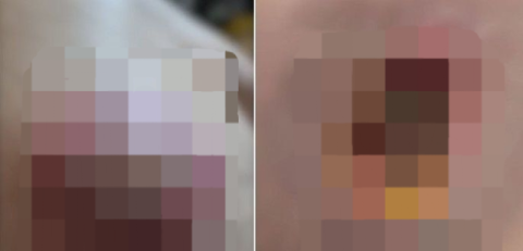 마사지 받다 잠들었는데 '점 제거'…中 마사지사 무단 시술에 피부 '괴사'