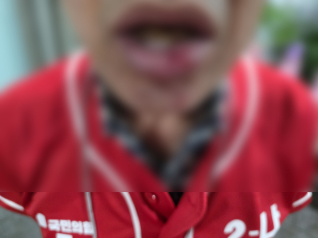21일 오후 대구 수성구 범물동에서 선거운동을 하던 중 행인에게 피습을 당한 박새롬 국민의힘 수성구의원 후보의 선거운동원 A씨가 아랫입술이 찢어졌다. 독자제공