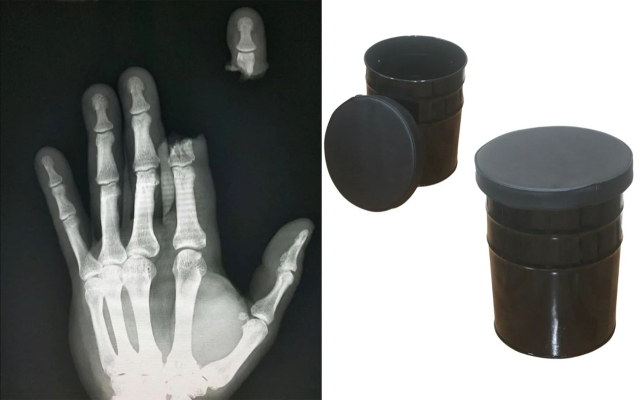 손가락 절단 사고 환자의 엑스레이(X-ray) 사진(왼쪽)과 고깃집 등에서 사용하는 원통형 수납 의자. 사진 이호형 교수 SNS 캡처
