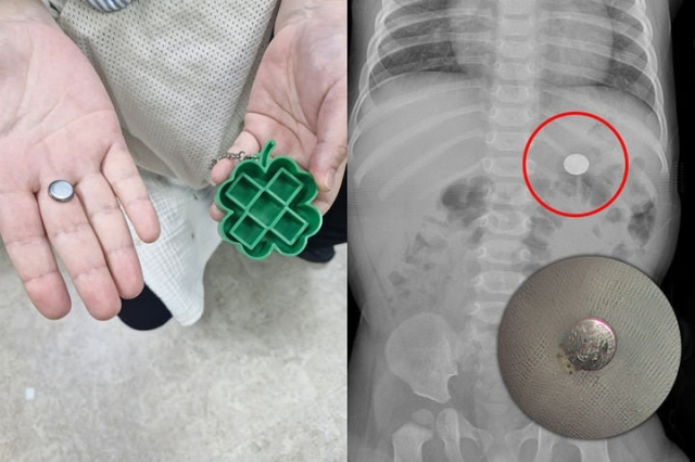생후 9개월 아기가 삼킨 건전지와 엑스레이 사진. [부산백병원 제공]